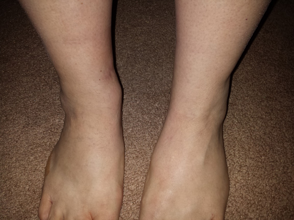 Ankle comparison
