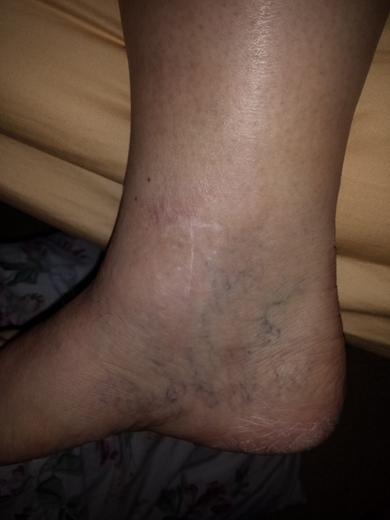 Inside right ankle - spider veins and all!