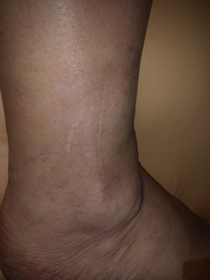 Outside of ankle - you can see the scar