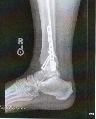 Right ankle xray, after healing.  This is a side view.