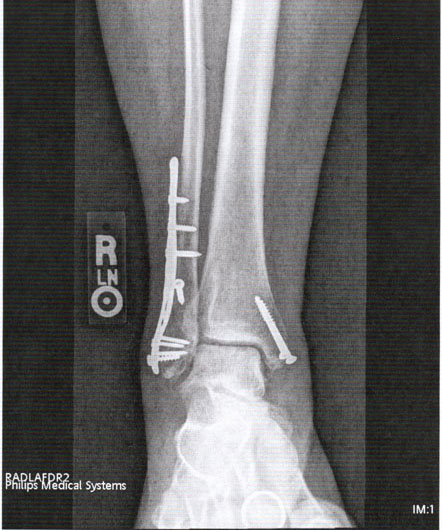 right ankle, front view xray, after healing