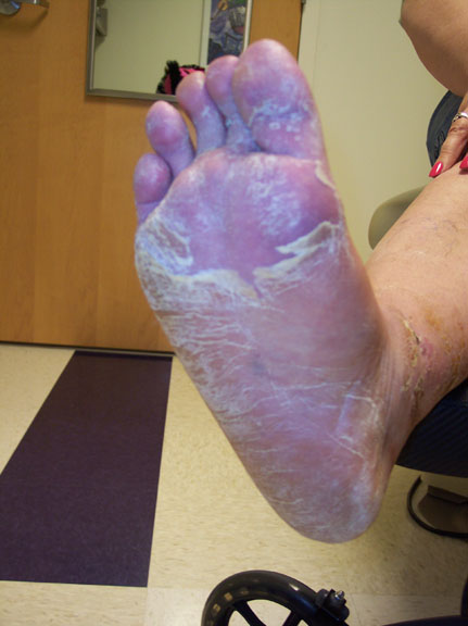 Dry skin on bottom of foot after wearing cast.