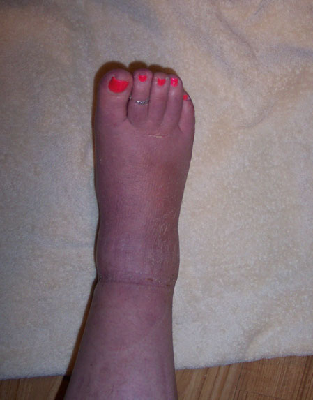 front of ankle after healing.