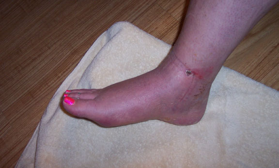 Left (inside) ankle with healed incision but healing fracture blister