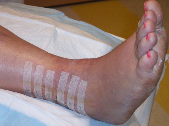 Outside of ankle Outside of ankle