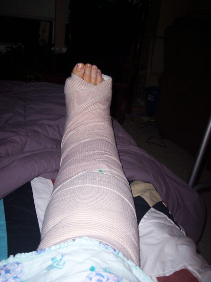 Broken Leg Broken Leg
