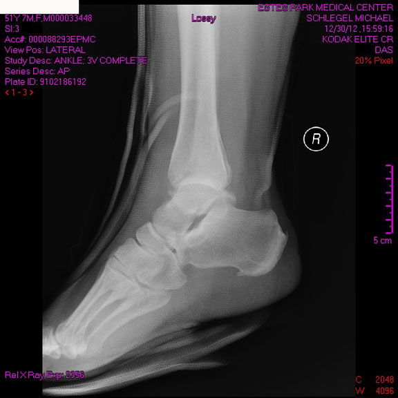 Side View broken ankle Side View broken ankle
